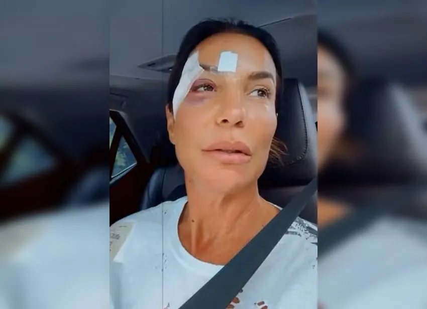 Ivete Sangalo deixa hospital com olho roxo e bom humor: 'Estou lançando maquiagem nova'